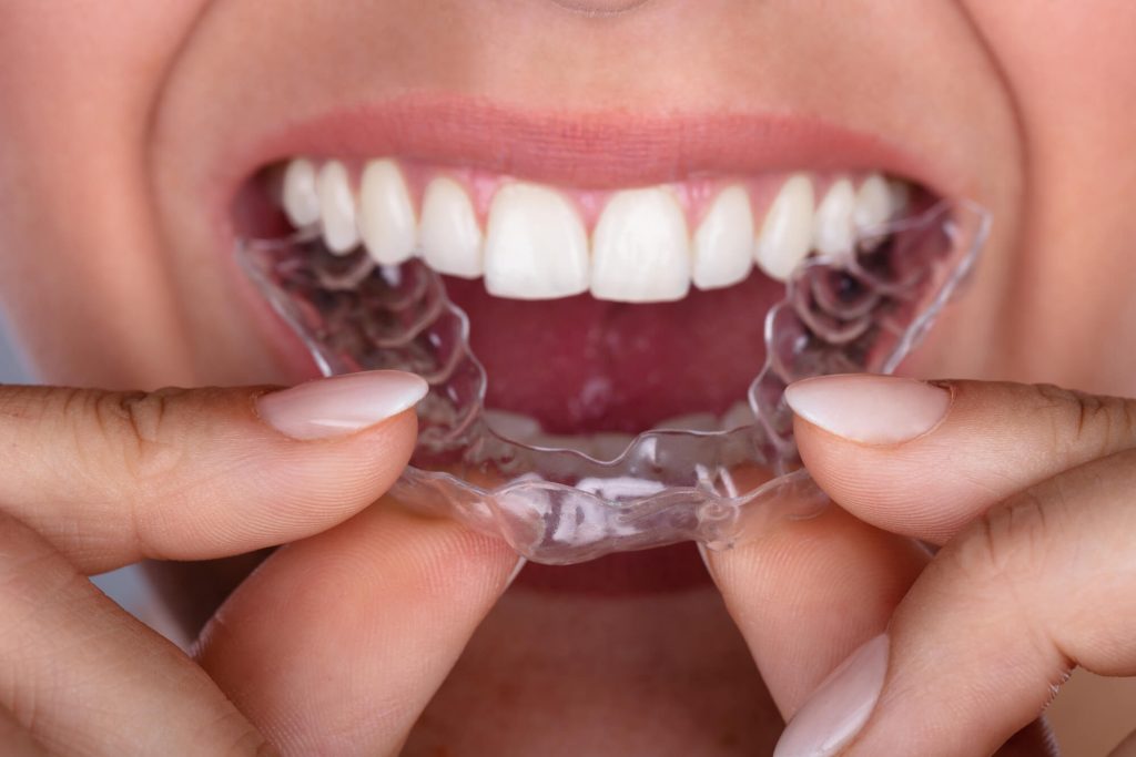 What is Airway Driven Orthodontic Expansion?