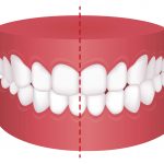 What is Expansion Orthodontics?