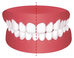 What is Expansion Orthodontics?