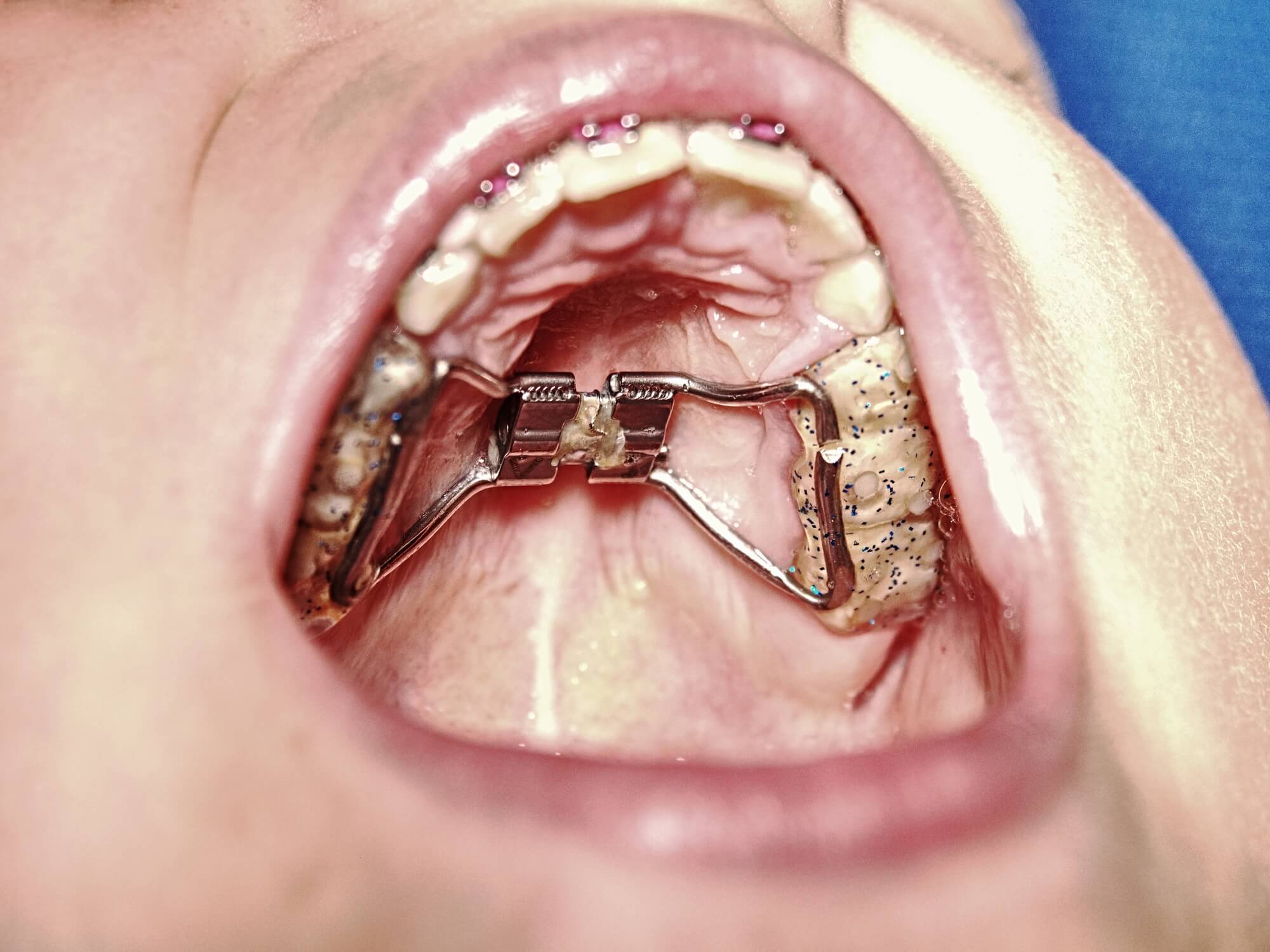 Different Types Of Appliances Used In Expansion Orthodontics Vero 