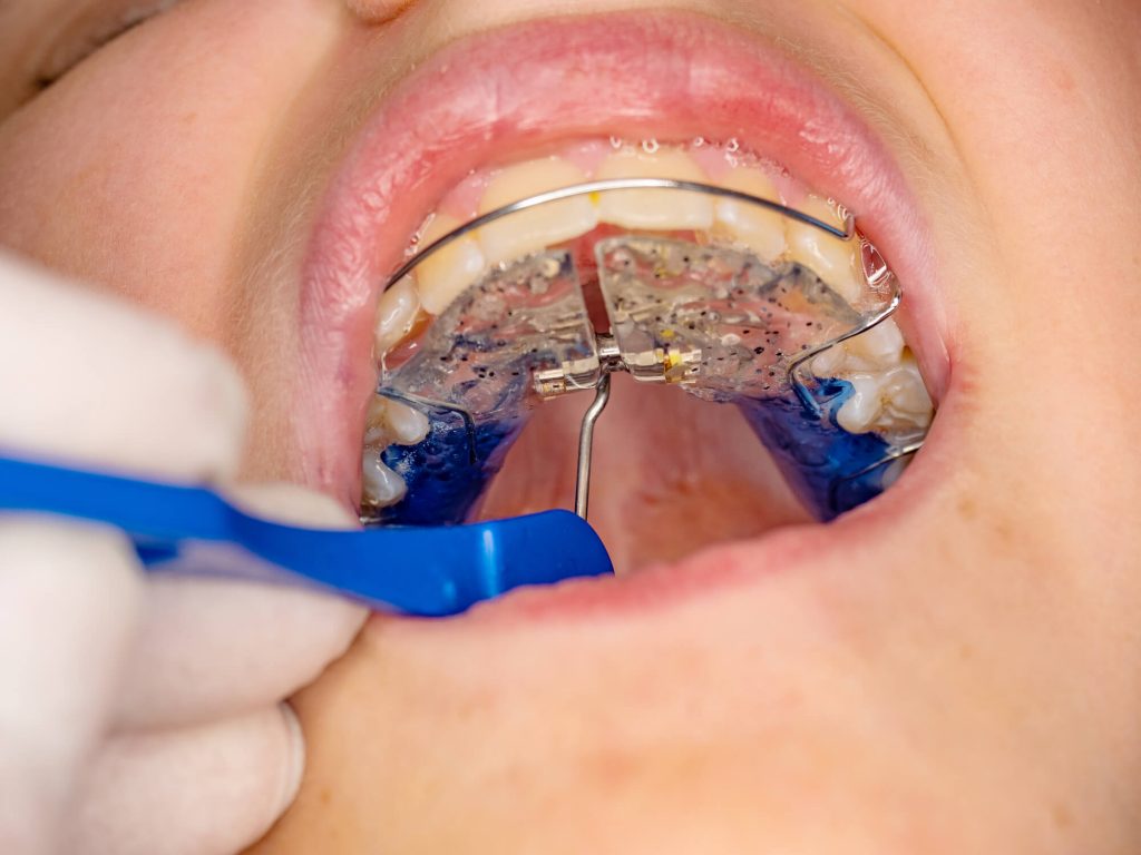 What is Expansion orthodontics?