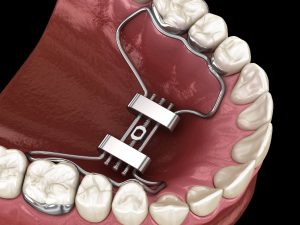 What is Airway Driven Orthodontic Expansion?